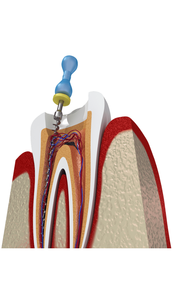 Endodoncia Talca Endodoncia Talca